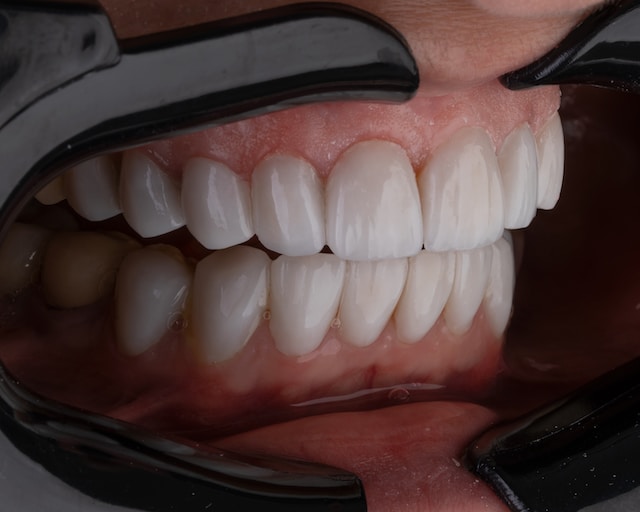 Tratamientos para el bruxismo: c�mo dejar de apretar y rechinar los dientes